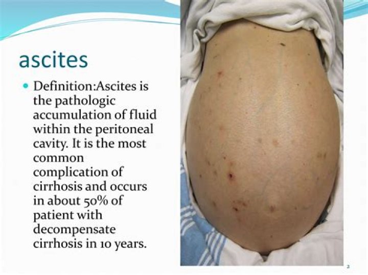 ascites medical definition