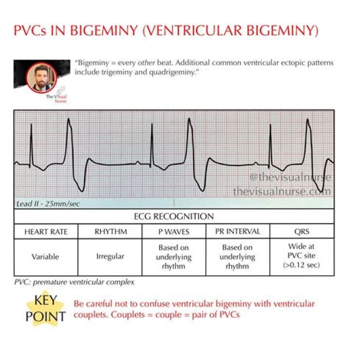 bigeminy treatment