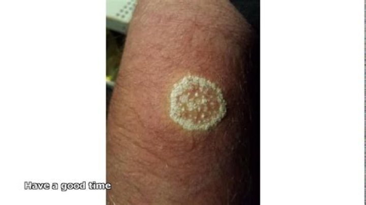 bleach on ringworm