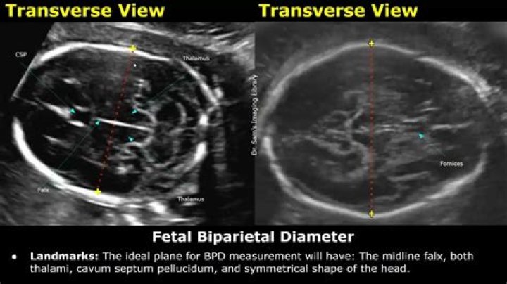bpd ultrasound