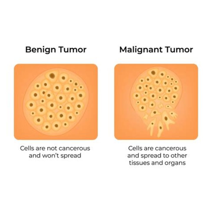 can a benign tumor become malignant
