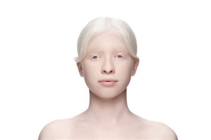 can albinos dye their hair