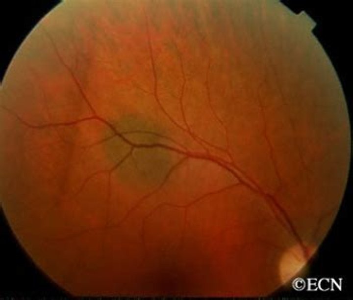 choroidal nevus icd 10
