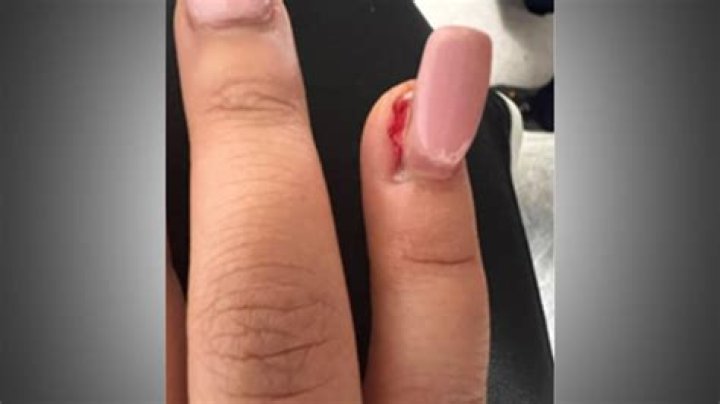 fingernail falling off