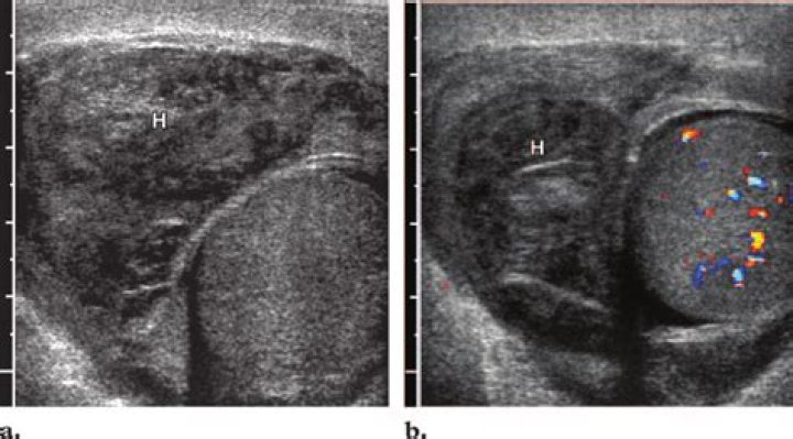 hernia testicular swelling