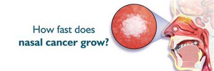 how fast does nasal cancer grow