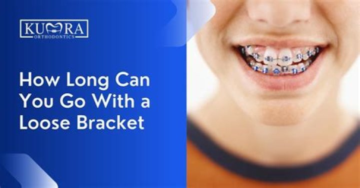 how long can you go with a loose bracket