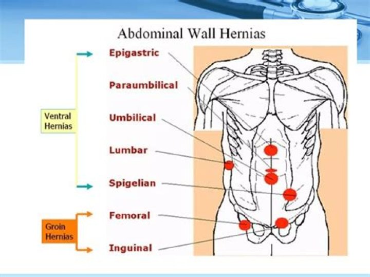icd 10 ventral hernia
