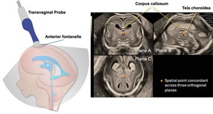neurosonography