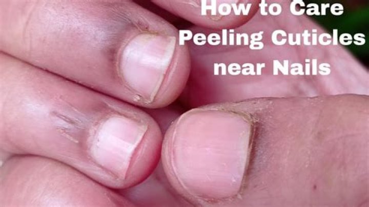 peeling cuticles