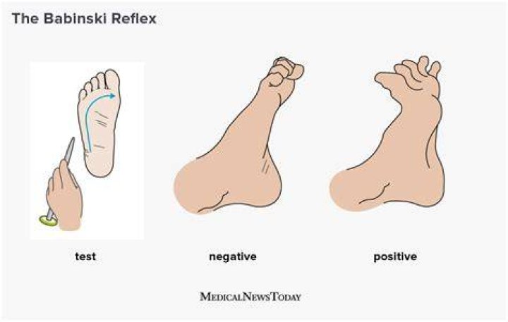 positive babinski reflex in adults