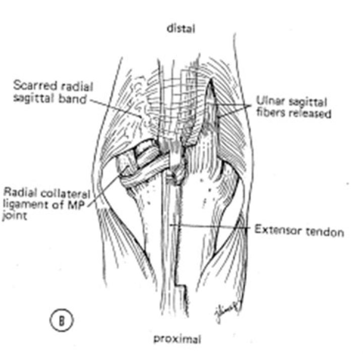 sagittal band rupture