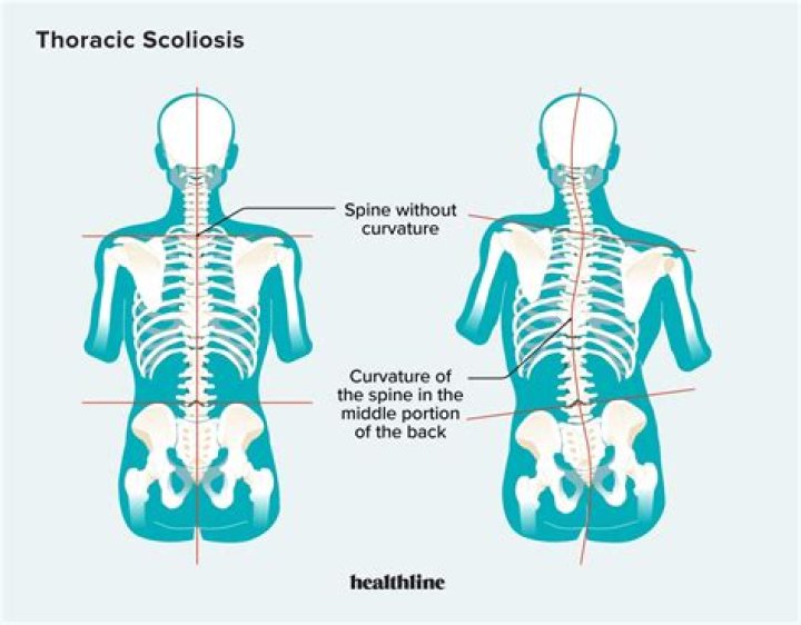 scolio