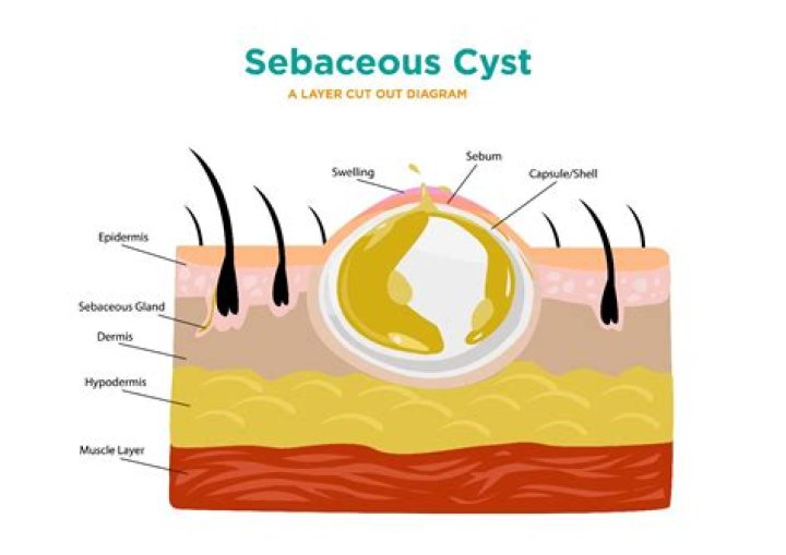 sebaceous filaments breasts