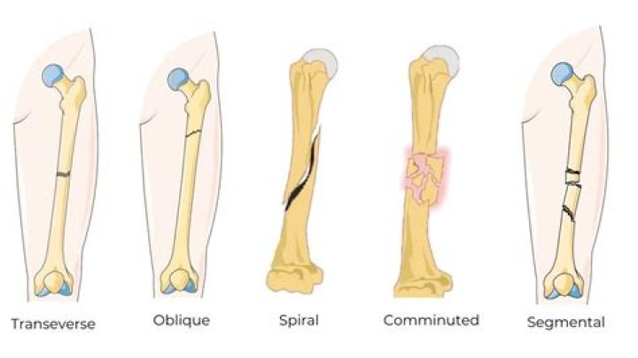 segmental fracture