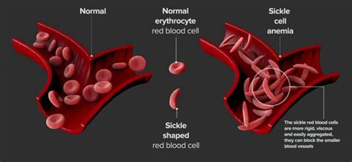 sickle cell definition