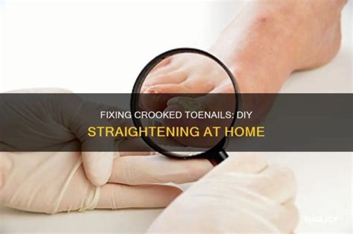 straightening toenails