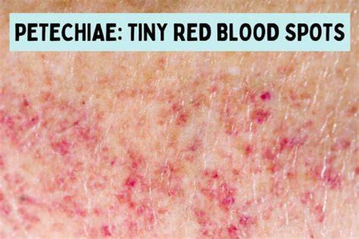 tiny blood spots on skin