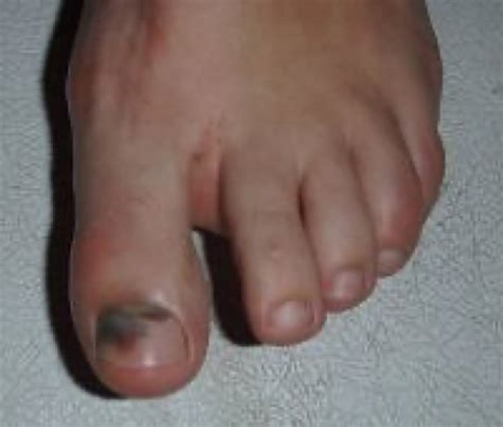 toes turn black