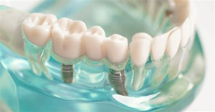 what are fake teeth called