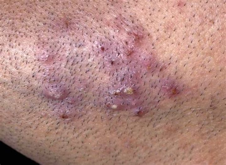 what do hair bumps look like on your private area