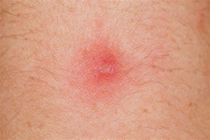 what is a papule