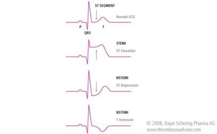 what is nstemi