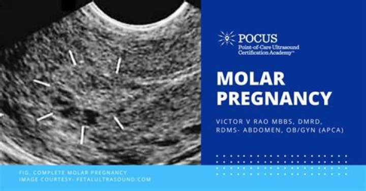 whats a molar pregnancy