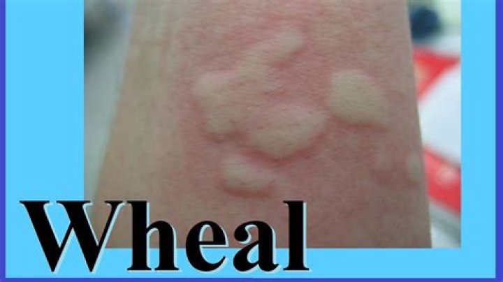 wheal medical definition